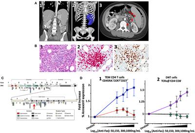 Paradoxical CD4 Lymphopenia in Autoimmune Lymphoproliferative Syndrome (ALPS)